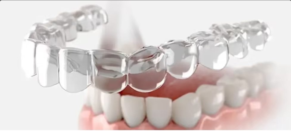 Aligners