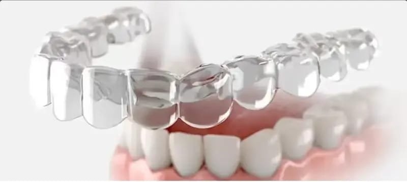 Aligners