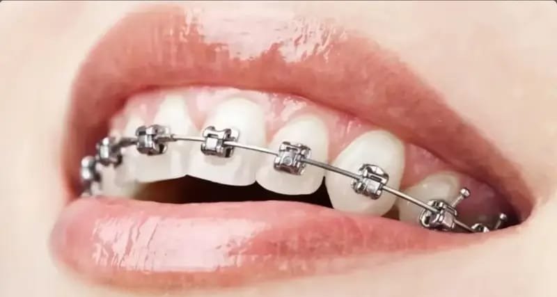 Orthodontics (Braces)